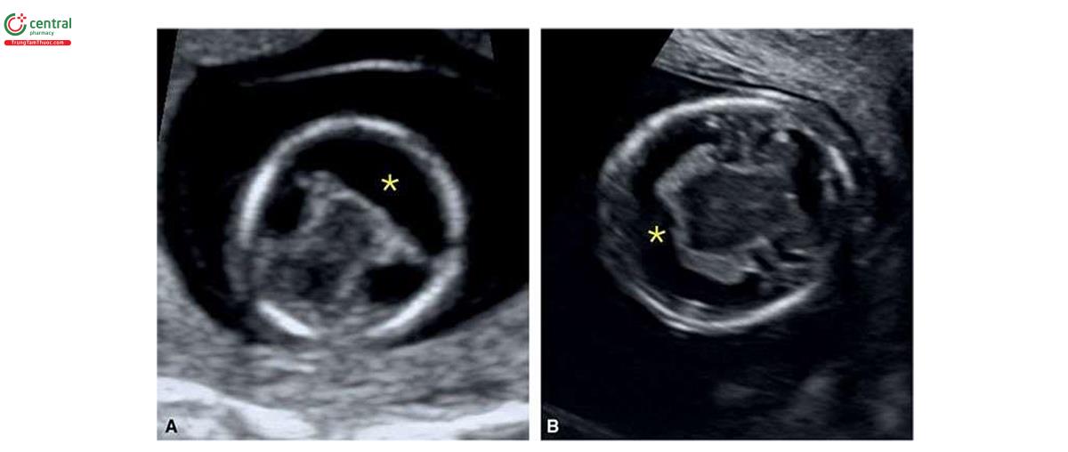 Hình 6.19: Mặt cắt ngang đầu ở 2 thai nhi (A và B) tương ứng 12 và 13 tuần tuổi bị trisomy 13 với não thất duy nhất thể không phân thùy (alobar holoprosencephaly) (dấu hoa thị). A thu được khi siêu âm qua thành bụng và B thu được khi siêu âm qua ngả âm đạo.