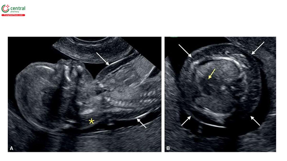 Hình 6.2: Mặt cắt dọc của đầu và ngực (A) và mặt cắt ngang ngực (B) ở thai nhi 13 tuần tuổi bị trisomy 21. Lưu ý, phù thai (fetal hydrops) sớm kèm theo phù dưới da toàn thân (mũi tên trắng ở A và B) và độ mờ da gáy dày (dấu hoa thị ở A). Cũng cần lưu ý kênh nhĩ thất (mũi tên vàng) ở B.