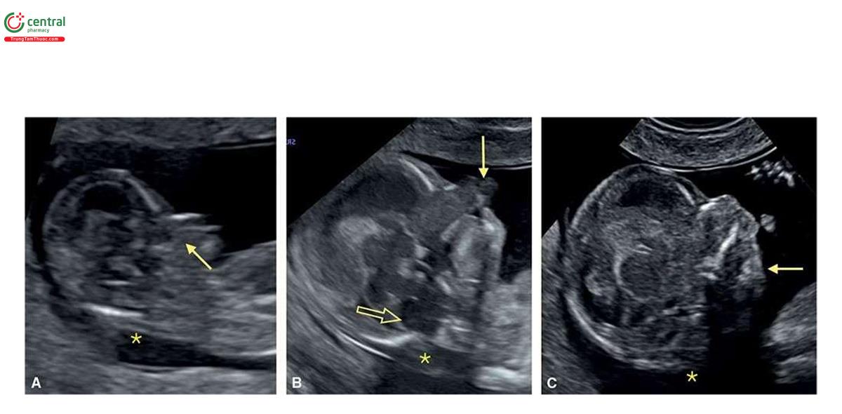 Hình 6.20: Trisomy 13 với dị tật mặt nghiêm trọng ở 3 thai nhi (A - C) tương ứng 13, 13 và 14 tuần tuổi. Thai nhi A cho thấy khe hở đường giữa kèm theo não thất duy nhất (holoproscephaly), không thấy hàm trên (mũi tên), và độ mờ da gáy (NT) (dấu hoa thị) không dày. Thai nhi B được siêu âm qua ngả âm đạo, cho thấy NT dày (dấu hoa thị), khe hở hai bên có phần lồi ra (mũi tên đặc) và dãn não thất bốn (mũi tên rỗng). Thai nhi C không có NT dày (dấu hoa thị), não thất bốn bình thường, và cằm tụt sau (retrognathia) (mũi tên). Cả 3 thai nhi đều có thêm những dị tật nghiêm trọng khác.