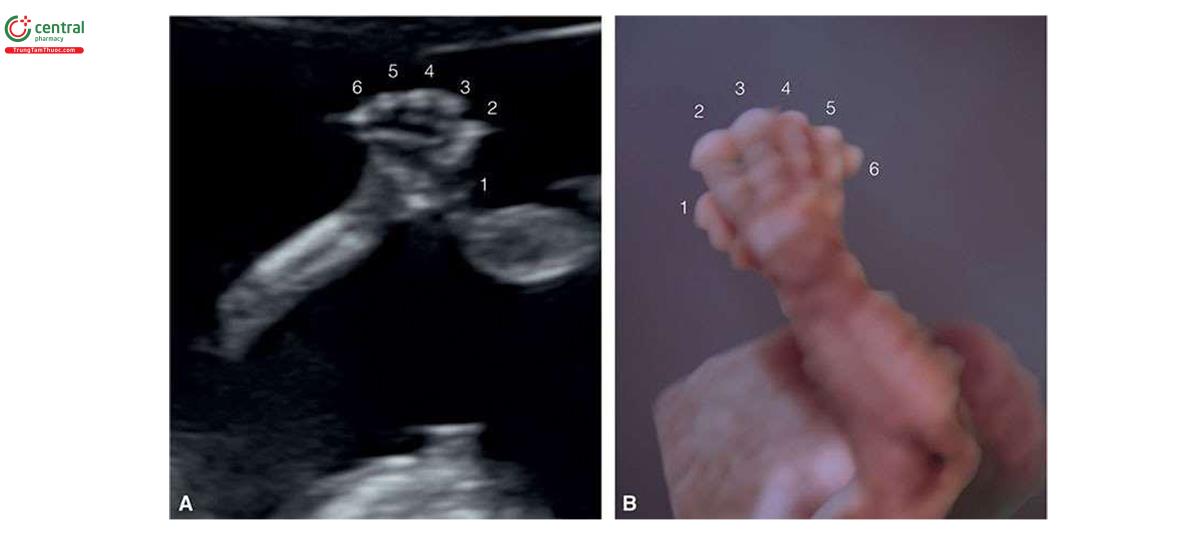 Hình 6.21: Tật thừa ngón (polydactyly) ở 2 thai nhi bị trisomy 13 lúc 14 tuần tuổi và trên siêu âm 2D ở thai nhi A và lúc 12 tuần tuổi và siêu âm 3D ở chế độ bề mặt ở thai nhi B.