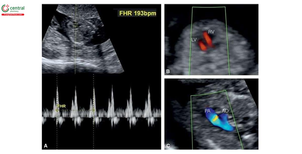 Hình 6.22: A: Nhịp tim thai nhanh trên Doppler xung van ba lá ở thai nhi 12 tuần tuổi bị trisomy 13, với tần số (FHR) 193 nhịp/phút. B: Mặt cắt bốn buồng với Doppler màu ở thai nhi 14 tuần tuổi bị trisomy 13. Lưu ý, ở B có sự đổ đầy tâm thất bất cân xứng kèm theo thất trái hẹp (LV). C: Mặt cắt ba mạch máu-khí quản của thai nhi cho thấy ở B. Lưu ý, ở C là cung động mạch chủ (AO) hẹp so với động mạch phổi (PA). Các dấu hiệu ở tim của thai nhi bị trisomy 13 rất hay gặp, bao gồm nhịp tim nhanh (> 175 nhịp/phút), nốt tăng âm trong tâm thất, động mạch dưới đòn phải lạc chỗ và bất thường tim, chủ yếu là tắc nghẽn đường ra thất trái. RV, tâm thất phải.