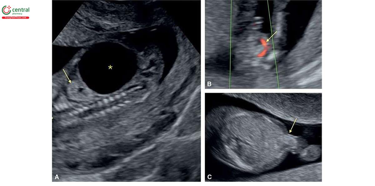 Hình 6.23: A: Mặt cắt dọc bên của bụng ở thai nhi 12 tuần tuổi bị trisomy 13 và các bất thường thận. Lưu ý, ở A có thận tăng âm (mũi tên) và bàng quang to (dấu hoa thị). Thai ở B cũng bị trisomy 13 lúc 14 tuần tuổi. Lưu ý, ở B chỉ có động mạch rốn duy nhất (single umbilical artery), một dấu hiệu tương tự như trisomy 18. Thai ở C bị trisomy 13 lúc 12 tuần tuổi và cho thấy thoát vị rốn nhỏ, một dấu hiệu thường thấy khác ở thai nhi bị trisomy18 ở tuổi thai nhỏ.
