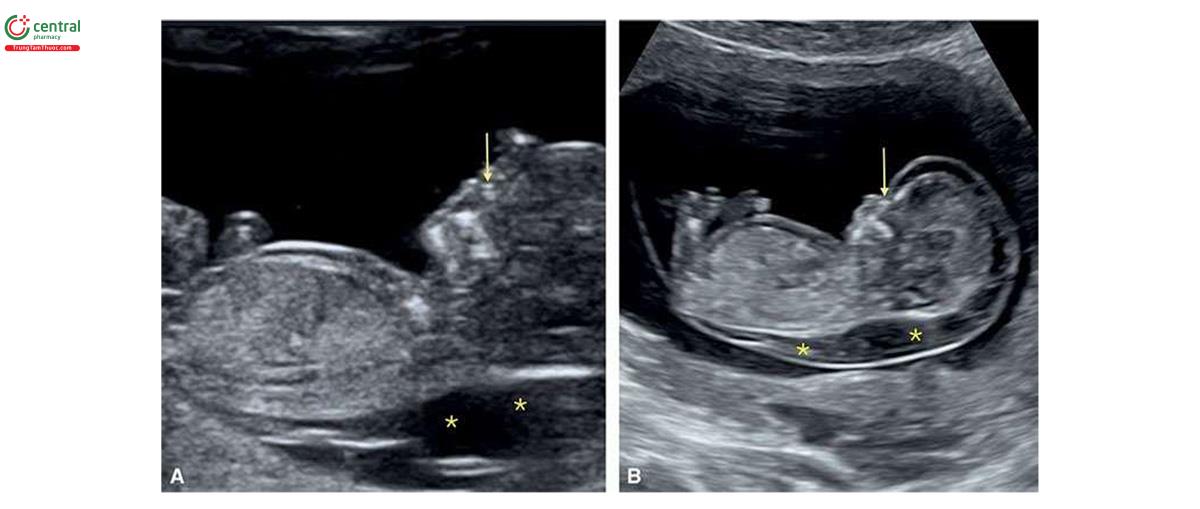 Hình 6.25: Mặt cắt dọc giữa cơ thể ở 2 thai nhi (A và B) bị monosomy X (hội chứng Turner) tương ứng ở 11 và 13 tuần tuổi. Lưu ý, độ mờ da gáy rất dày (dấu hoa thị) ở A và phù thai và nang bạch huyết ở B. Tuổi mẹ thường không cao và xương mũi thường được cốt hóa (mũi tên). 