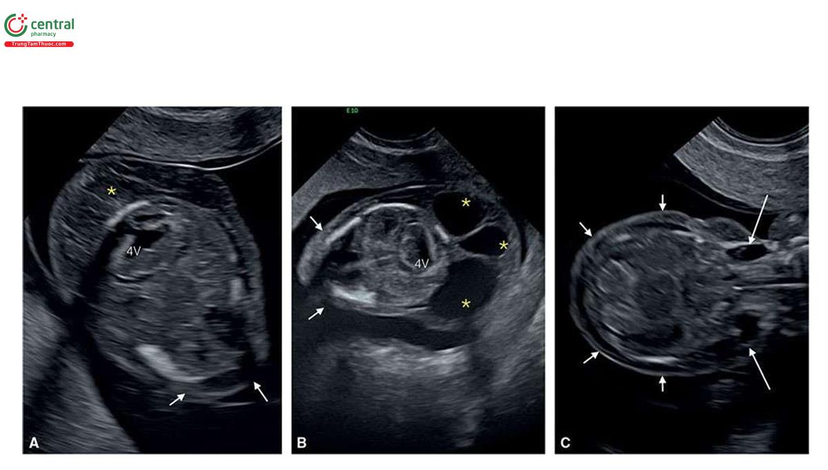 Hình 6.26: Ba thai nhi (A - C) bị hội chứng Turner và có bất thường ở cổ, tất cả đều ở 13 tuần tuổi. Thai nhi A và B có nang bạch huyết (dấu hoa thị), trong khi thai nhi C có nang ở cổ bên (mũi tên dài). Phù da đầu thấy ở tất cả thai nhi (mũi tên ngắn). Các cấu trúc nội sọ bình thường ở tất cả các thai nhi. 4V, não thất bốn.
