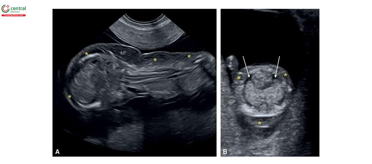 Hình 6.27: A: Mặt cắt dọc giữa cơ thể ở thai nhi 13 tuần tuổi bị monosomy X. Lưu ý ở A có độ mờ da gáy rất dày (NT) / nang bạch huyết với phù cơ thể (dấu hoa thị). B: Mặt cắt ngang ngực ở một thai nhi 11 tuần tuổi khác bị monosomy X. Lưu ý, ở B có tràn dịch màng phổi hai bên (các mũi tên). H, tim.
