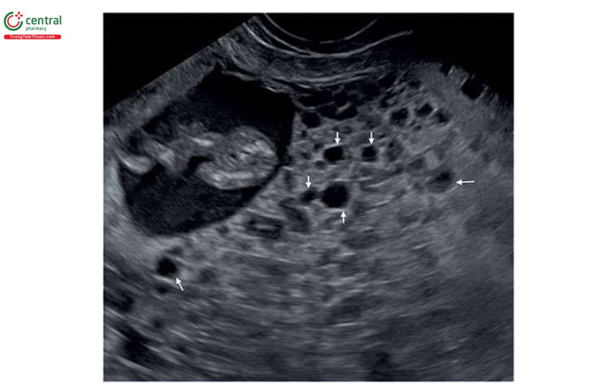 Hình 6.29: Siêu âm nhau thai ở thai nhi 11 tuần tuổi với thể tam bội có nguồn gốc từ bố. Lưu ý, nhau thai trứng (mũi tên). Xem văn bản để biết thêm chi tiết.