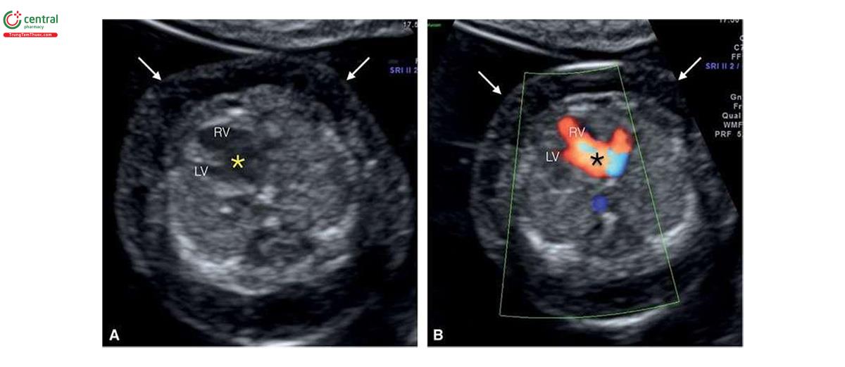 Hình 6.3: Mặt cắt bốn buồng tim ở thai nhi 12 tuần tuổi bị trisomy 21 trên siêu âm 2D (A) và Doppler màu (B). Lưu ý, có kênh nhĩ thất (dấu hoa thị) ở A và B, là bất thường tim điển hình của hội chứng này. Cũng lưu ý, tình trạng phù toàn thân kèm theo (mũi tên), thoái triển lúc 16 tuần khi siêu âm theo dõi. Xem Hình 6.4 để biết thêm các “marker” của trisomy 21 trên siêu âm quý 1. LV, tâm thất trái; RV, tâm thất phải.