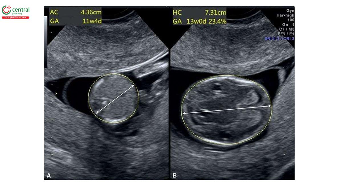 Hình 6.30: Mặt cắt ngang bụng (A) và đầu (B) ở thai nhi 12 tuần tuổi với thể tam bội có nguồn gốc từ mẹ. Lưu ý, sự khác biệt rõ rệt về kích thước giữa chu vi bụng (A) và chu vi đầu (B), > "2 tuần” tuổi thai. Xem văn bản để biết thêm chi tiết.
