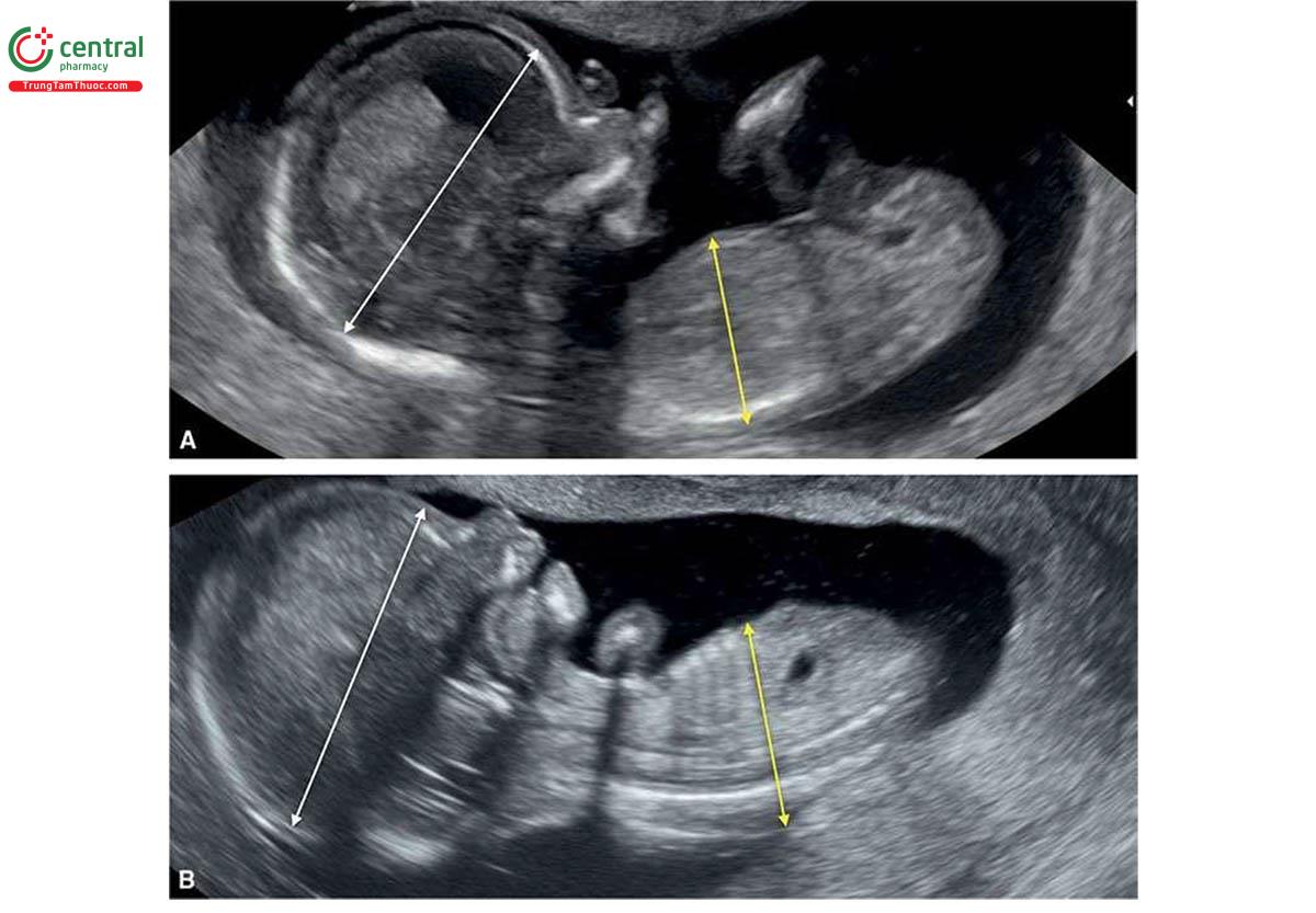 Hình 6.31: Mặt cắt dọc giữa cơ thể ở 2 thai nhi (A và B) 13 tuần tuổi với thể tam bội có nguồn gốc từ mẹ. Lưu ý, cả 2 thai nhi có sự khác biệt rõ rệt về kích thước giữa bụng (mũi tên vàng) và đầu (mũi tên trắng). Sự khác biệt về kích thước giữa đầu và bụng này là một dấu hiệu bệnh lý gần như đặc trưng của thể tam bội có nguồn gốc từ mẹ. Ngoài ra, chiều dài đầu-mông ngắn đáng kể, phản ánh có tình trạng thai giới hạn tăng trưởng sớm. Xem 6.32 với 3D ở chế độ bề mặt (surface mode).