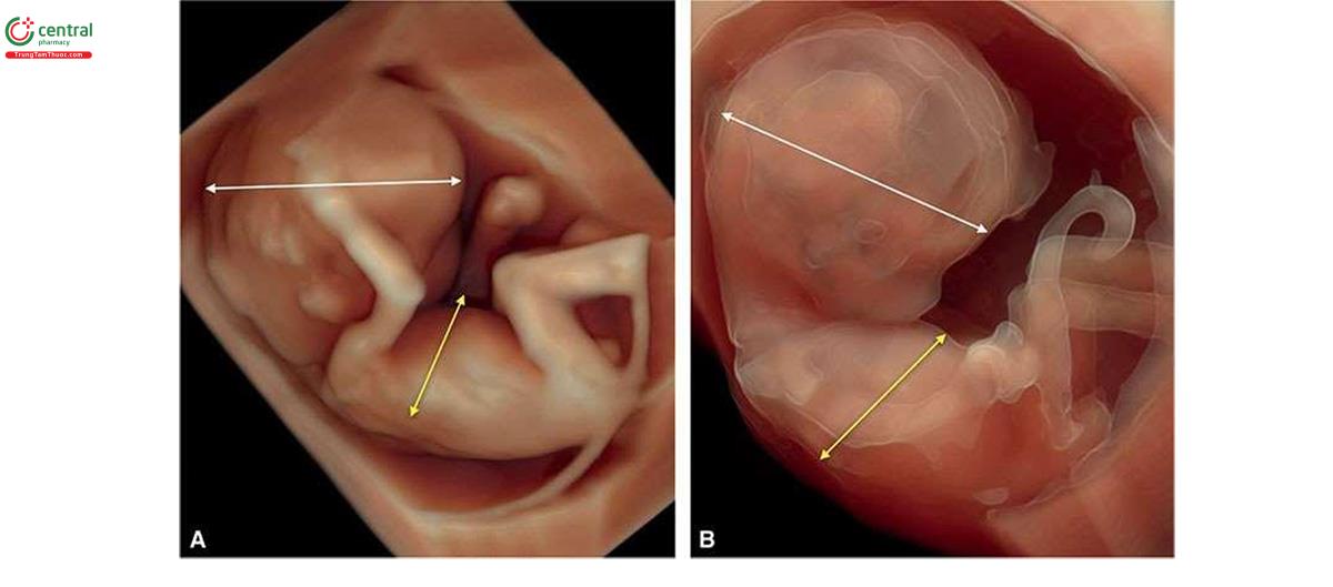 Hình 6.32: Siêu âm 3D với chế độ bề mặt ở 2 thai nhi (A và B) với thể tam bội có nguồn gốc từ mẹ; các thai nhi giống như trong Hình 6.31. Lưu ý, sự khác biệt rõ rệt về kích thước giữa bụng (mũi tên vàng) và đầu (mũi tên trắng) ở cả 2 thai nhi. Xem văn bản để biết thêm chi tiết.