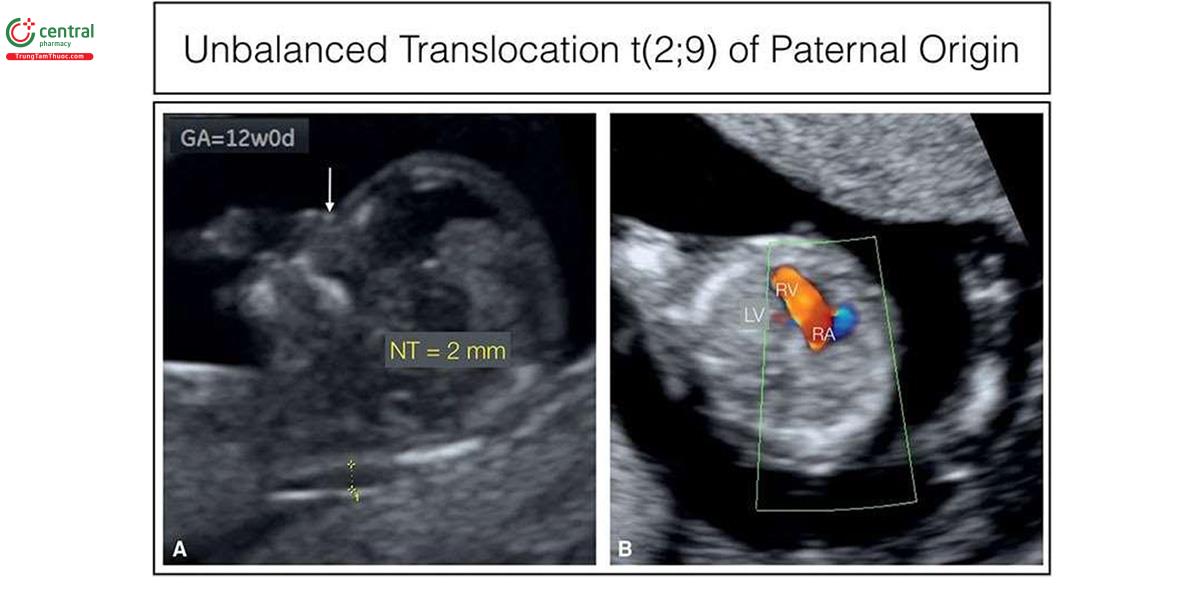 Hình 6.33: Hình này cho thấy khuôn mặt thai nhi (A) và mặt cắt bốn buồng tim với Doppler màu, thu được qua siêu âm ngả âm đạo (B) ở một bệnh nhân mang thai 30 tuổi được giới thiệu đến để sàng lọc độ mờ da gáy (NT) lúc 12 tuần tuổi. A: NT 2 mm, trong giới hạn bình thường và không có xương mũi (mũi tên). B: Thiểu sản thất trái (LV), nghi ngờ hội chứng thiểu sản tim trái bởi chỉ thấy dòng máu qua nhĩ phải (RA) và thất phải (RV) trên Doppler màu. Sinh thiết gai nhau cho thấy monosomy bán phần (partial) 9q và trisomy bán phần 2p là chuyển đoạn không cân bằng (unbalanced translocation). Nhiễm sắc thể đồ của bố mẹ cho thấy chuyển đoạn không cân bằng chưa từng được biết trước đó ở bố. 