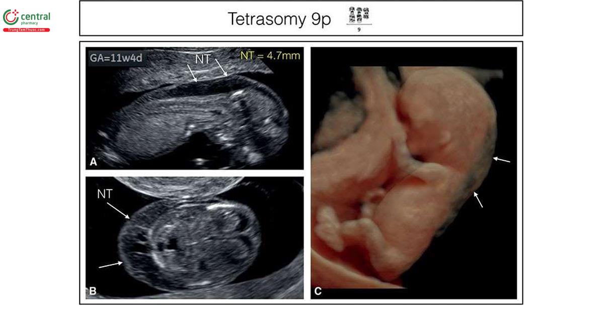 Hình 6.34: A: Độ mờ da gáy dày (4,7 mm) ở thai nhi 11 tuần tuổi. B: Mặt cắt ngang đầu tương ứng và C là siêu âm 3D ở chế độ bề mặt (surface mode). Lưu ý, độ mờ da gáy dày (NT) ở B và C cho thấy khoảng sáng dày ở mặt lưng của thai nhi (mũi tên). Ở giai đoạn này, không thấy có bất thường nào khác. Sinh thiết gai nhau với nuôi cấy tế bào thời gian dài (prolonged cell culture) cho thấy tetrasomy 9p.