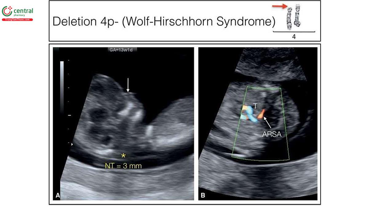 Hình 6.35: Thai phụ 40 tuổi này được giới thiệu đến để siêu âm sàng lọc quý 1. Độ mờ da gáy (NT) 3 mm (dấu hoa thị) đồng thời không có xương mũi (mũi tên) như cho thấy ở hình A. Động mạch dưới đòn phải lạc chỗ (ARSA) cũng được phát hiện ở B với đường đi sau khí quản (T). Chúng tôi nghĩ nhiều đến trisomy 21. Nuôi cấy tế bào thời gian dài từ mẫu bệnh phẩm sinh thiết gai nhau cho thấy mất đoạn 4p- (mũi tên đỏ). Không có phần xa của nhánh ngắn nhiễm sắc thể số 4. Hãy nhớ rằng, xét nghiệm tiền sản không xâm lấn sẽ bỏ sót chẩn đoán trong tình trạng như vậy. 