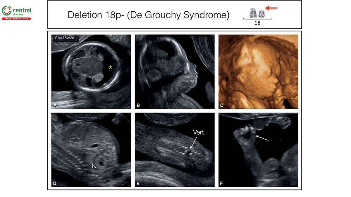 Hình 6.36: Siêu âm quý 1 ở thai nhi 13 tuần tuổi cho thấy não thất duy nhất thể không thùy (alobar holoprosencephaly) (dấu hoa thị) ở A, mặt bất thường ở B và C, thận loạn sản (dysplastic kidneys) (K) ở D, dị tật đốt sống (Vert.) ở E, và các ngón tay nắm chặt (clenched fingers) (mũi tên) ở F. Sinh thiết gai nhau cho thấy mất đoạn nhánh nhỏ của nhiễm sắc thể 18 (mũi tên đỏ). Mất đoạn 18p thường liên quan với não thất duy nhất (holoproscephaly) vì gen TGIF hiện diện trên nhánh ngắn của nhiễm sắc thể 18 cũng như các dị tật về cột sống và vv... Hãy nhớ rằng, xét nghiệm tiền sản không xâm lấn sẽ bỏ sót chẩn đoán trong tình trạng như vậy.
