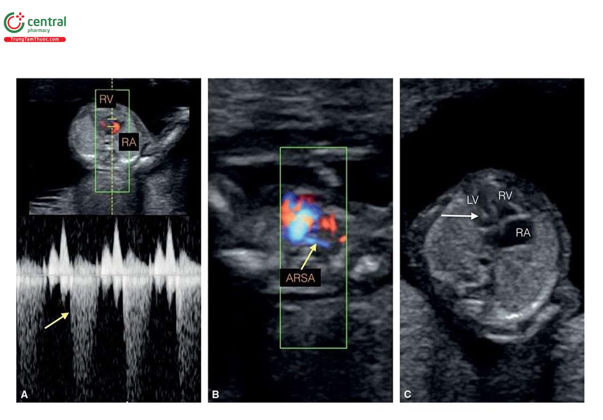 Hình 6.4: Các dấu hiệu khác trên siêu âm ở thai nhi bị trisomy 21 trong quý 1. Hở van ba lá cho thấy ở A trên Doppler màu và xung (mũi tên), hướng đi bất thường của động mạch dưới đòn phải (ARSA) cho thấy ở B và nốt tăng âm trong tim cho thấy ở tâm thất trái (LV) ở C (mũi tên). RA, tâm nhĩ phải; RV, tâm thất phải.