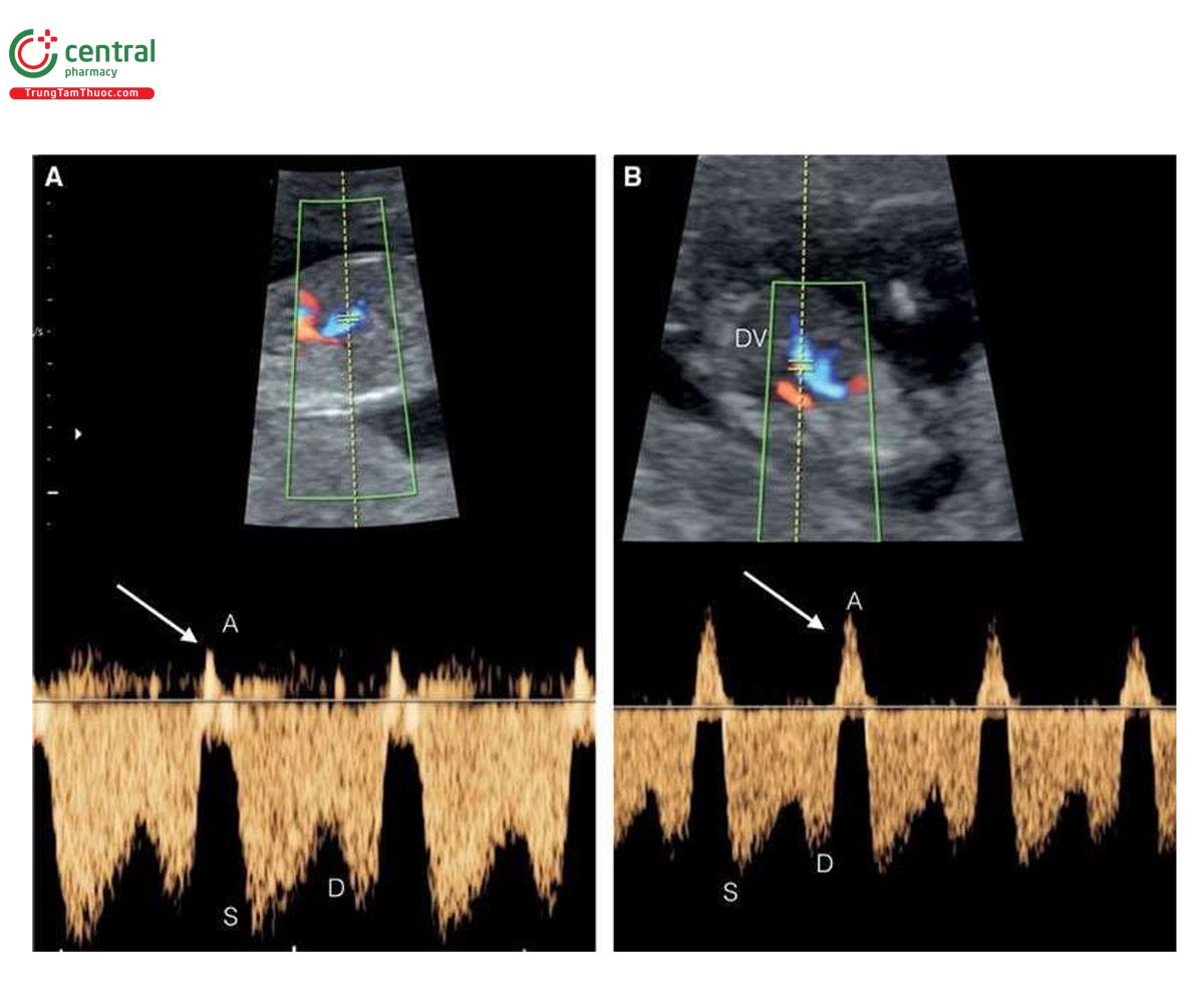 Hình 6.5: Đánh giá dòng chảy Doppler ống tĩnh mạch (DV) ở 2 thai nhi 13 tuần tuổi bị trisomy 21 (A và B). Lưu ý, có dòng chảy ngược ở pha tâm nhĩ co bóp (A) trong chu chuyển tim (mũi tên). Thai nhi A không có dị tật tim kèm theo, trong khi thai nhi B có dị tật tim, điều này có thể giải thích cho dòng chảy ngược nặng hơn của sóng A (mũi tên ở B). Phổ Doppler bình thường của ống tĩnh mạch cho thấy dòng chảy xuôi dòng (antegrade flow) trong suốt chu chuyển tim với trở kháng thấp. S, dòng chảy tâm thu; D, dòng chảy tâm trương.