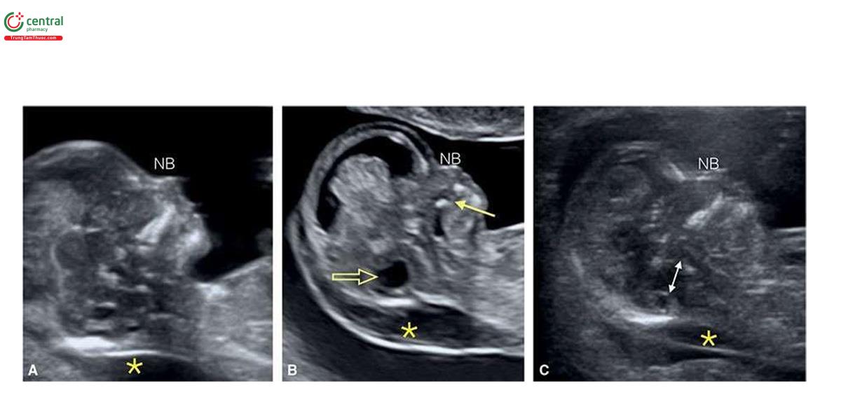 Hình 6.8: Mặt cắt dọc giữa mặt ở 3 thai nhi (A-C) bị trisomy 18 tương ứng ở tuổi thai 13, 12 và 14 tuần. Lưu ý, độ mờ da gáy bình thường (NT) ở A, NT tăng nhẹ ở C, và NT tăng rõ rệt ở B. Cả 3 thai nhi đều không có xương mũi hoặc xương mũi cốt hóa kém (NB). Hố sau là một dấu hiệu thú vị của trisomy 18 và có thể bình thường như ở thai A, nhưng thường bị dãn như ở thai B (mũi tên rỗng) và đôi khi bị chèn ép như ở thai C (mũi tên hai đầu) khi có tật chẻ đôi đốt sống thể hở (open spina bifida). Thai A được chẩn đoán bị trisomy 18 do có bất sản xương quay (radius aplasia) (xem Hình 6.14) và các bất thường ở tim. Thai B có khe hở hàm trên (mũi tên) gợi ý khe hở mặt (facial cleft).