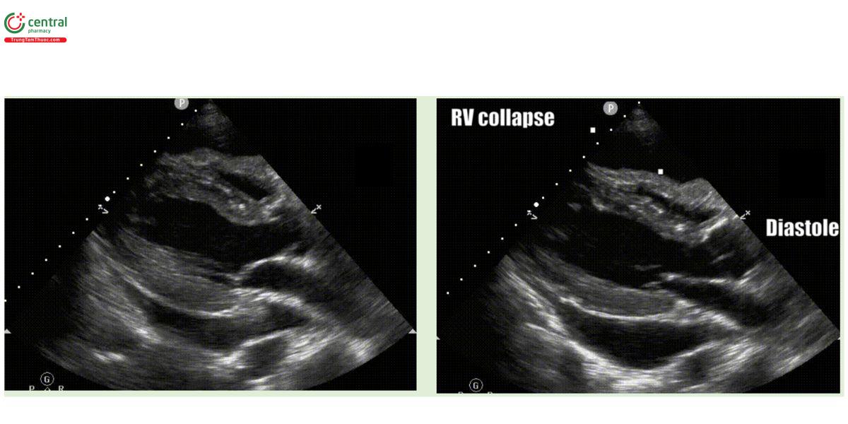 Sinh lý tamponade. Cả hai clip đều tương ứng với cùng một trường hợp. Trên máy siêu âm, bạn có thể tạm dừng một clip và quay lại từng khung hình. Ý tưởng ở đây là đánh giá chuyển động của tâm thất phải sau khi van hai lá mở ra cho đến khi nó đóng lại.
