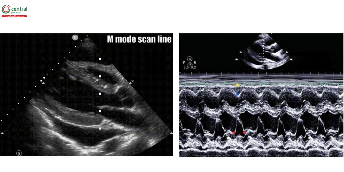Chế độ M-mode với chèn ép tim. Ở bên trái, một đường quét chọn các đỉnh của van hai lá trong mặt cắt trục dọc cạnh ức. Ở bên phải, chế độ M-mode đã được bật. Tâm trương bắt đầu và kết thúc giữa các chấm đỏ và thể hiện sự chuyển động của van hai lá. Chấm màu vàng là đường biểu thị màng ngoài tim. Chấm màu xanh tượng trưng cho đường viền thượng tâm mạc của RV. Chúng ta có thể đánh giá sự xẹp thì tâm trương của RV trong hình ảnh này.