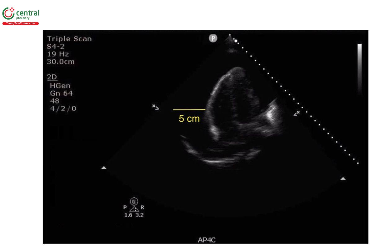 Hình 1c: Mặt cắt 4 buồng đỉnh, B-mode: Tràn dịch màng ngoài tim