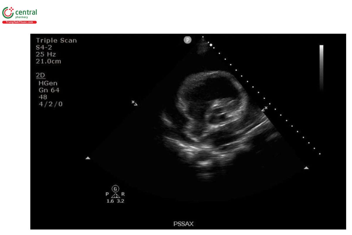 Hình 2: Mặt cắt trục ngắn cạnh ức: Tràn dịch màng ngoài tim