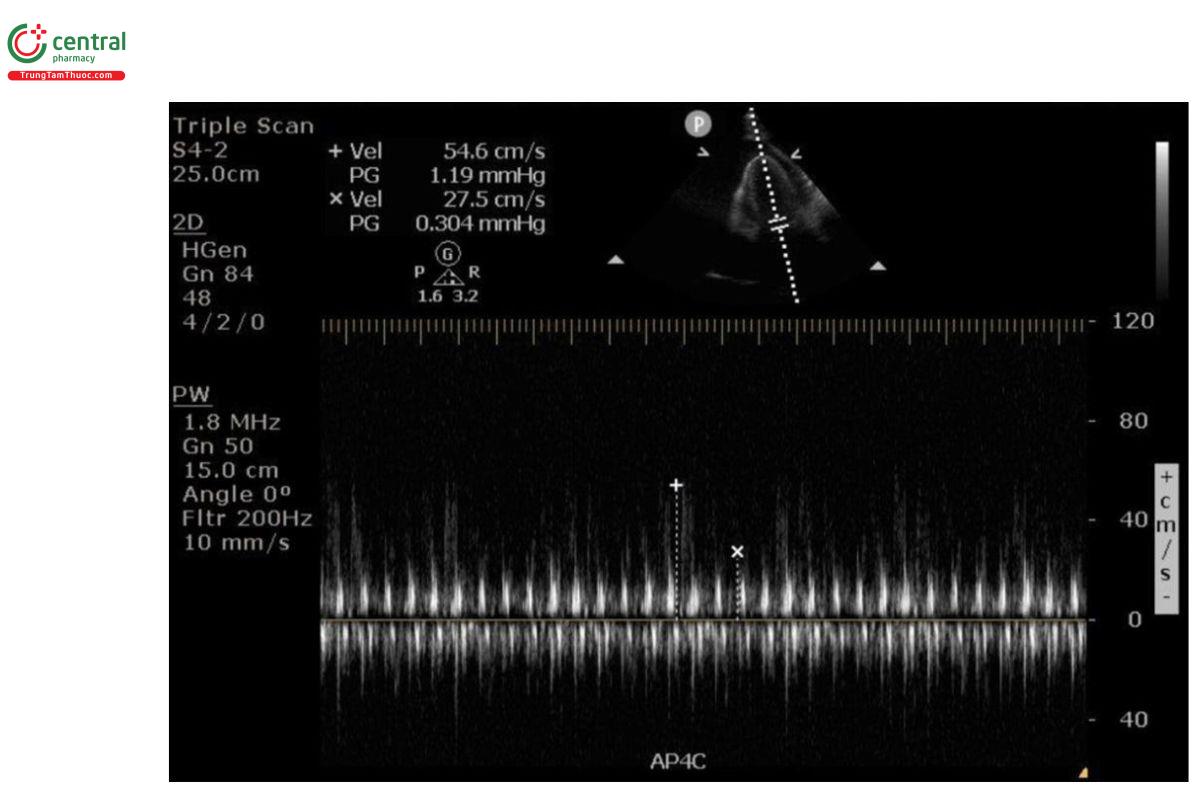 Hình 5:  Mặt cắt trục dài cạnh xương ức, Doppler sóng xung: Sự biến thiên theo hô hấp của tốc độ dòng vào hai lá. Tốc độ chậm cho phép đánh giá một số chu kỳ hô hấp