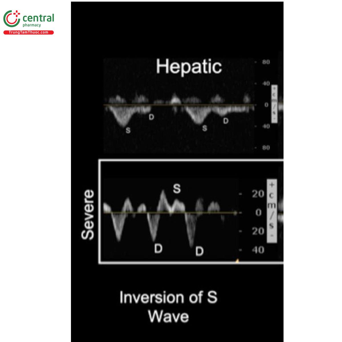 Hình 6: Chế độ Doppler tĩnh mạch gan: hàng trên là bình thường và hàng dưới là dòng máu đảo ngược trong tĩnh mạch gan
