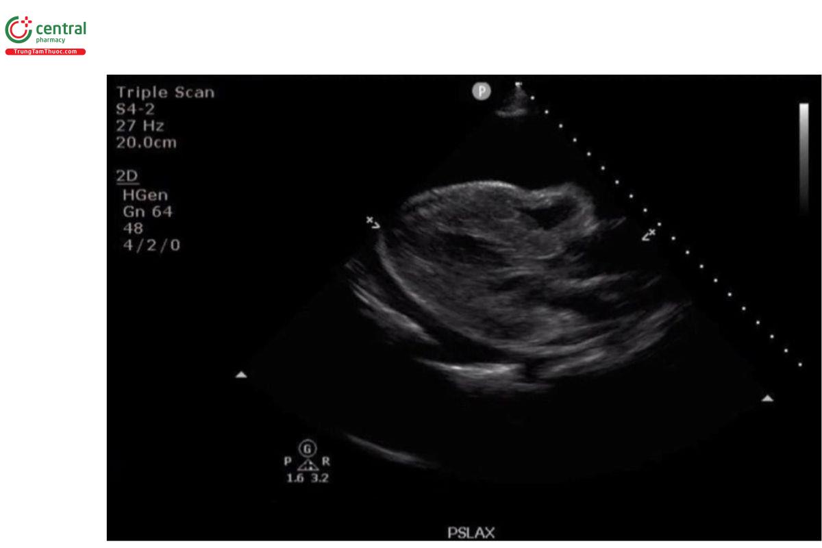 Hình 1a: Mặt cắt trục dài cạnh ức, B-mode: Tràn dịch màng ngoài tim