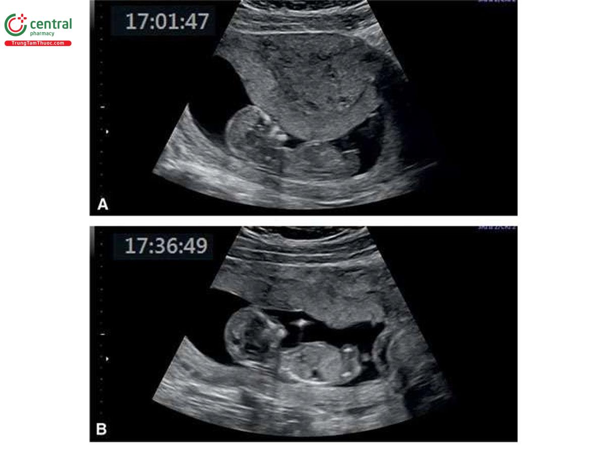 Hình 5.1: A: Siêu âm qua thành bụng trong quý 1 cho thấy một cơn co ở giữa tử cung, đang giữ thai nhi ở phần giữa của buồng tử cung. Chúng tôi đã không thể hoàn thành cuộc siêu âm mặc dù đã thử siêu âm qua ngả âm đạo. Siêu âm được lặp lại 35 phút sau đó (B), cho thấy cơn co đã thoái triển, hình ảnh đã được tối ưu hóa và thai nhi cử động tự do trong buồng tử cung.
