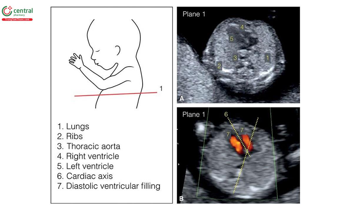 Hình 5.11: Lồng ngực thai nhi được đánh giá ở 2 mặt cắt: mặt cắt bốn buồng tim và mặt cắt ba mạch máu-khí quản. Hình này cho thấy mặt cắt 1, là mặt cắt bốn buồng tim.