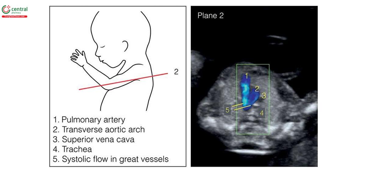 Hình 5.12: Lồng ngực của thai nhi được đánh giá ở 2 mặt cắt: mặt cắt bốn buồng tim (mặt cắt 1, cho thấy trong Hình 5.11) và mặt cắt ba mạch máu-khí quản (mặt cắt 2) được cho thấy ở đây. Mặt cắt 2 được đánh giá tốt nhất với Doppler màu cho thấy động mạch phổi, động mạch chủ, tĩnh mạch chủ trên và khí quản. Mặt cắt này cho phép phát hiện các dị tật tim phức tạp trong quý 1. Xem Bảng 5.8, văn bản và Chương 11 để biết thêm chi tiết. Chú thích 1