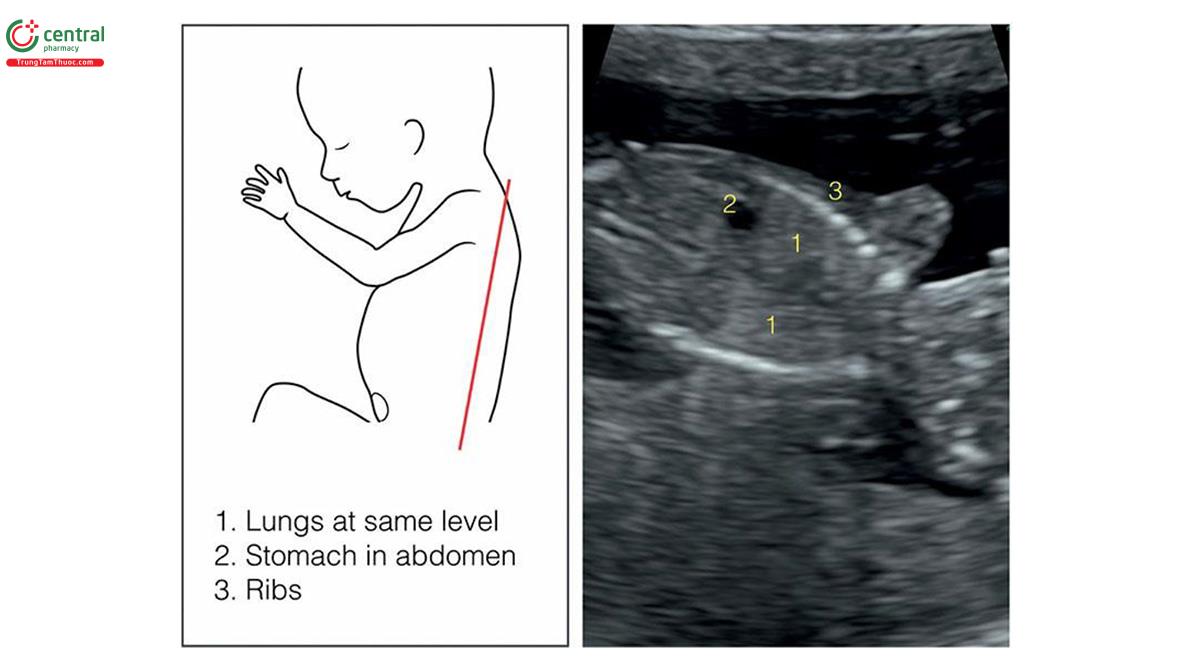 Hình 5.13: Mặt cắt vành của ngực và bụng thai nhi để đánh giá cơ hoành khi nghi ngờ thoát vị hoành. Mặt cắt này cho thấy cả 2 phổi ở cùng một mức và dạ dày và gan trong ổ bụng. Xem văn bản và Chương 11 để biết thêm chi tiết.