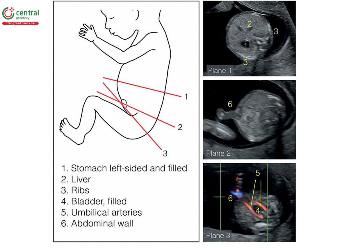 Hình 5.14: Ba mặt cắt ngang (mặt cắt 1-3) đánh giá giải phẫu bụng thai nhi. Mặt cắt 1 ở mức dạ dày và cho thấy vị trí bình thường của dạ dày và gan. Mặt cắt 2 ở mức dây rốn cắm vào bụng và cho thấy thành bụng trước nguyên vẹn và mặt cắt 3 là mặt cắt có thêm Doppler màu ở mức bàng quang xác nhận bàng quang cùng với 2 động mạch rốn. Xem Bảng 5.9 và văn bản để biết thêm chi tiết.