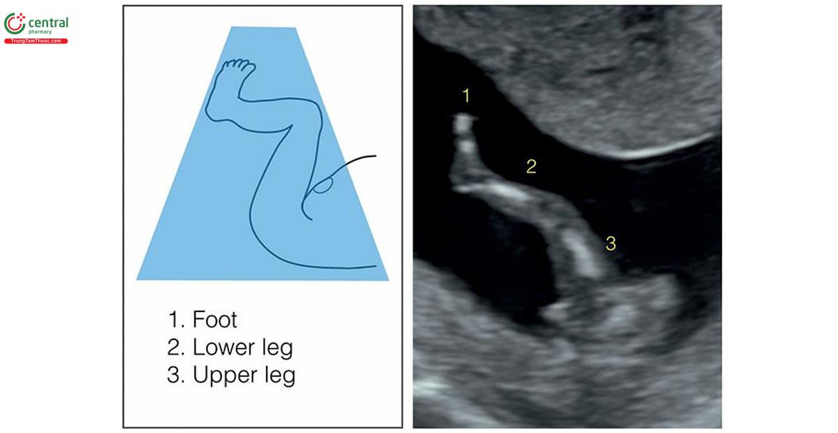 Hình 5.19: Mặt cắt dọc bên-chếch cho thấy 3 đoạn của chi dưới: đùi (3), cẳng chân (2) và bàn chân với các ngón (1). Bàn chân với các ngón thường được thấy rõ hơn trong quý 1 so với giai đoạn sau của thai kỳ.