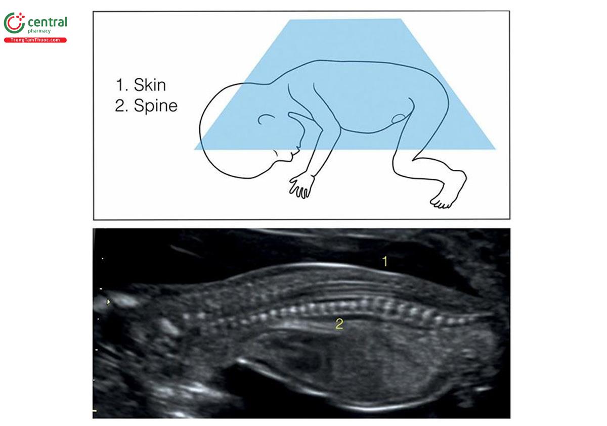 Hình 5.22: Mặt cắt dọc giữa của thai nhi ở tư thế nằm sấp cho thấy cột sống. Lưu ý, bắt đầu có sự cốt hóa các thân đốt sống và lớp da nguyên vẹn bao phủ lưng. Xem Bảng 5.11 và văn bản để biết thêm chi tiết.