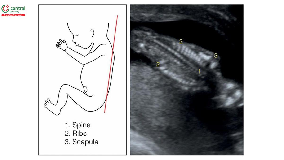Hình 5.23: Mặt cắt vành ở phía sau của thai nhi cho thấy cột sống, xương vai và lồng ngực. Mặt cắt này rất hữu ích khi nghi ngờ có biến dạng cột sống. Xem Bảng 5.11 và văn bản để biết thêm chi tiết.