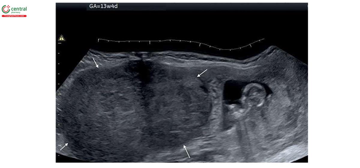 Hình 5.26: U xơ cơ tử cung lớn có 2 thùy (mũi tên) ở vùng đáy lúc 13 tuần tuổi. Kích thước khối u xơ cơ tử cung lớn làm giảm kích thước túi thai. U xơ cơ tử cung quá lớn để có thể thấy được trên một hình ảnh và chế độ xem toàn cảnh (panorama view) đã được áp dụng.