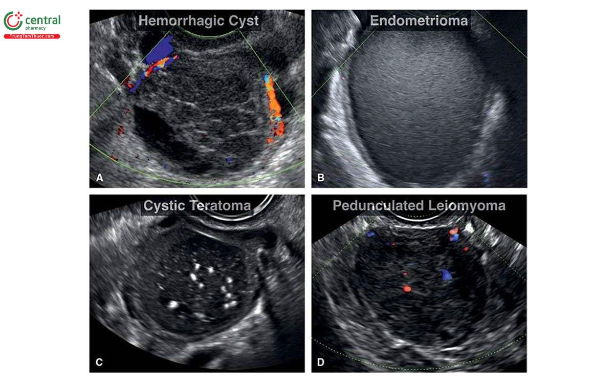 Hình 5.27: Các khối u phần phụ hay gặp trong quý 1. Nang xuất huyết (A) cho thấy dạng lưới đặc trưng và mức dịch (reticular pattern and fluid level), u lạc nội mạc tử cung (B) cho thấy hình ảnh kính mờ đơn thùy (unilocular ground-glass appearance), u quái dạng nang (cystic teratoma) (C) với các nốt tăng âm do nhũ hóa chất béo (fat emulsion) và u xơ cơ tử cung có cuống (pedunculated leiomyoma) (D) với hình ảnh khối đặc và có rất ít mạch máu trên Doppler màu. Doppler màu cho thấy không có tín hiệu mạch trong nang xuất huyết và u lạc nội mạc tử cung.