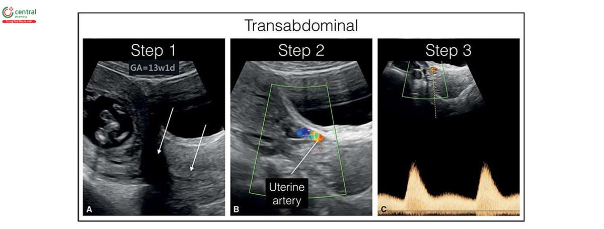 Hình 5.29: Các bước cần thực hiện để thu được phổ Doppler động mạch tử cung với siêu âm qua thành bụng. Bước 1: Thấy cổ tử cung ở mặt cắt dọc trên siêu âm 2D (mũi tên). Bước 2: Bật Doppler màu và nghiêng đầu dò sang trái hoặc phải ở mặt cắt dọc bên cho đến khi thấy động mạch tử cung bên trái hoặc phải tương ứng. Thấy động mạch tử cung bắt chéo các mạch máu hạ vị. Bước 3: Đặt cửa sổ Doppler xung vào động mạch tử cung.