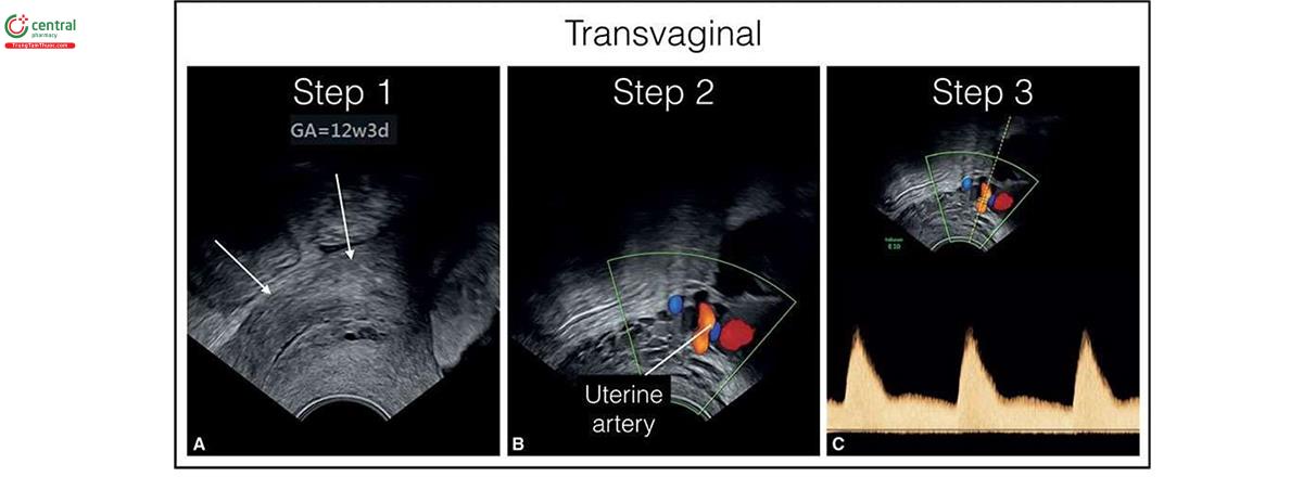 Hình 5.30: Các bước cần thực hiện để thu được phổ Doppler động mạch tử cung với siêu âm qua ngả âm đạo. Bước 1: Thấy cổ tử cung ở mặt cắt dọc trên siêu âm 2D (mũi tên). Bước 2: Bật Doppler màu và nghiêng đầu dò sang trái hoặc phải ở mặt cắt dọc bên cho đến khi thấy động mạch tử cung bên trái hoặc phải tương ứng. Thấy động mạch tử cung bắt chéo các mạch máu hạ vị. Bước 3: Đặt cửa sổ Doppler xung vào động mạch tử cung. Hình ảnh ở đây bị đảo ngược so với Hình 5.29 vì đây là cách hiển thị hình ảnh phụ khoa truyền thống của một số cơ sở y tế.