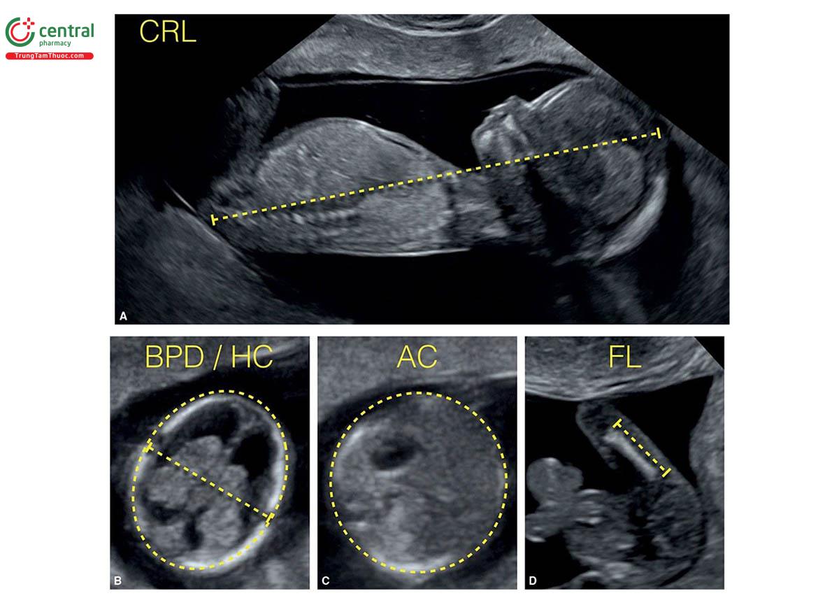 Hình 5.4: Đo các chỉ số sinh trắc học của thai nhi trong quý 1 bao gồm chiều dài đầu - mông (CRL) cho thấy ở hình A, đường kính lưỡng đỉnh (BPD) và chu vi đầu (HC) cho thấy ở hình B, chu vi bụng (AC) cho thấy ở hình C và chiều dài xương đùi ( FL) cho thấy ở hình D.