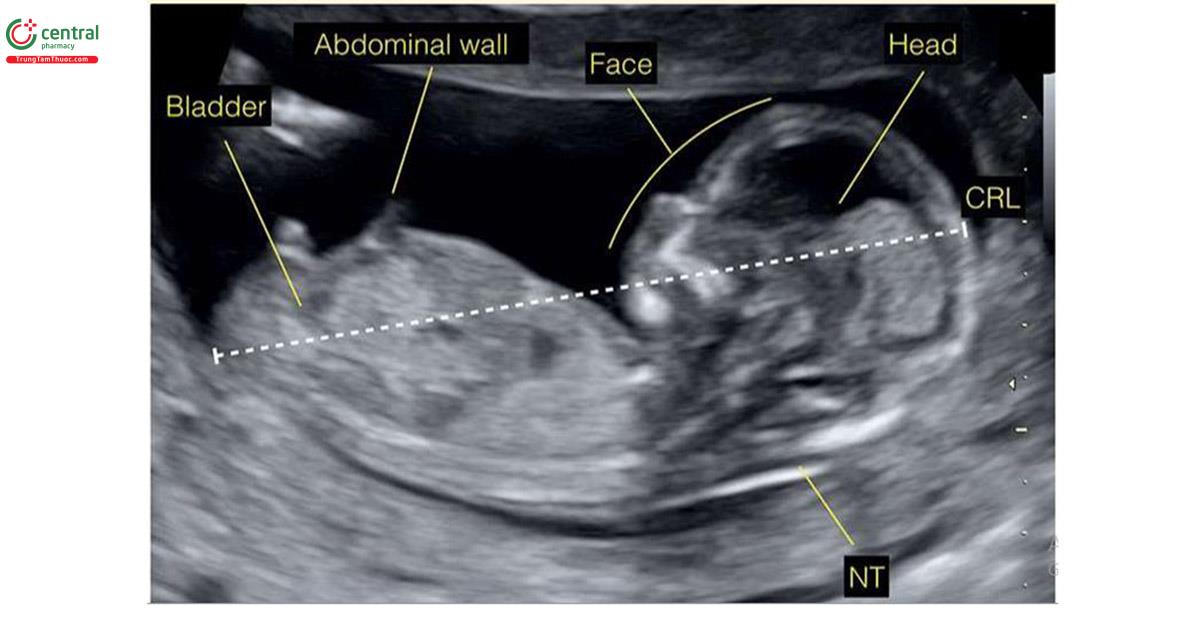 Hình 5.5: Mặt cắt dọc giữa của thai nhi ở tư thế nằm ngửa cho phép đánh giá một số vùng giải phẫu quan trọng như đầu, mặt, độ mờ da gáy (NT), thành bụng và bàng quang. Xem Bảng 5.4 và văn bản để biết thêm chi tiết. CRL, chiều dài đầu-mông.