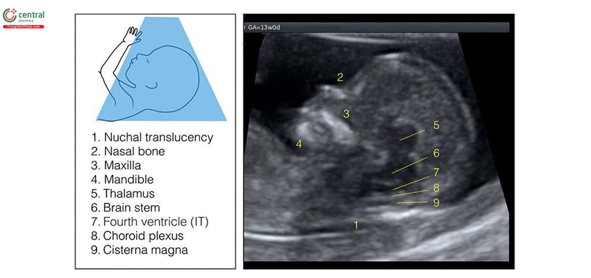 Hình 5.6: Mặt cắt dọc giữa đầu thai nhi cho thấy một danh sách các vùng giải phẫu giúp đánh giá toàn diện khuôn mặt và não. Xem Bảng 5.5 và 5.6 và văn bản để biết thêm chi tiết. IT, khoảng sáng nội sọ. Chú thích: 1 độ mờ da gáy, 2 xương mũi, 3 xương hàm trên, 4 xương hàm dưới, 5 đồi thị, 6 thân não, 7 não thất bốn (IT), 8 đám rối mạch mạc, 9 bể lớn.