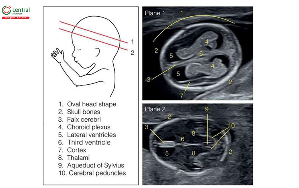 Hình 5.7: Mặt cắt 1 và 2 trong số 4 mặt cắt ngang để đánh giá hình dạng đầu thai nhi: Mặt cắt 1 tương ứng với mặt cắt ngang não thất bên và mặt cắt 2 tương ứng với mặt cắt ngang đồi thị. Xem Bảng 5.7 và văn bản để biết thêm chi tiết. Mặt cắt 1 và 2 ở thai nhi 13 tuần tuổi và được thực hiện bằng đầu dò phẳng qua thành bụng. Xem Hình 5.8 và 5.9 lần lượt cho các mặt cắt 3 và 4. Chú thích 1 đầu hình bầu dục, 2 xương hộp sọ, 3 liềm não, 4 đám rối mạch mạc, 5 não thất bên, 6 não thất ba, 7 vỏ não, 8 đồi thị, 9 cống Sylvius, 10 cuống đại não.