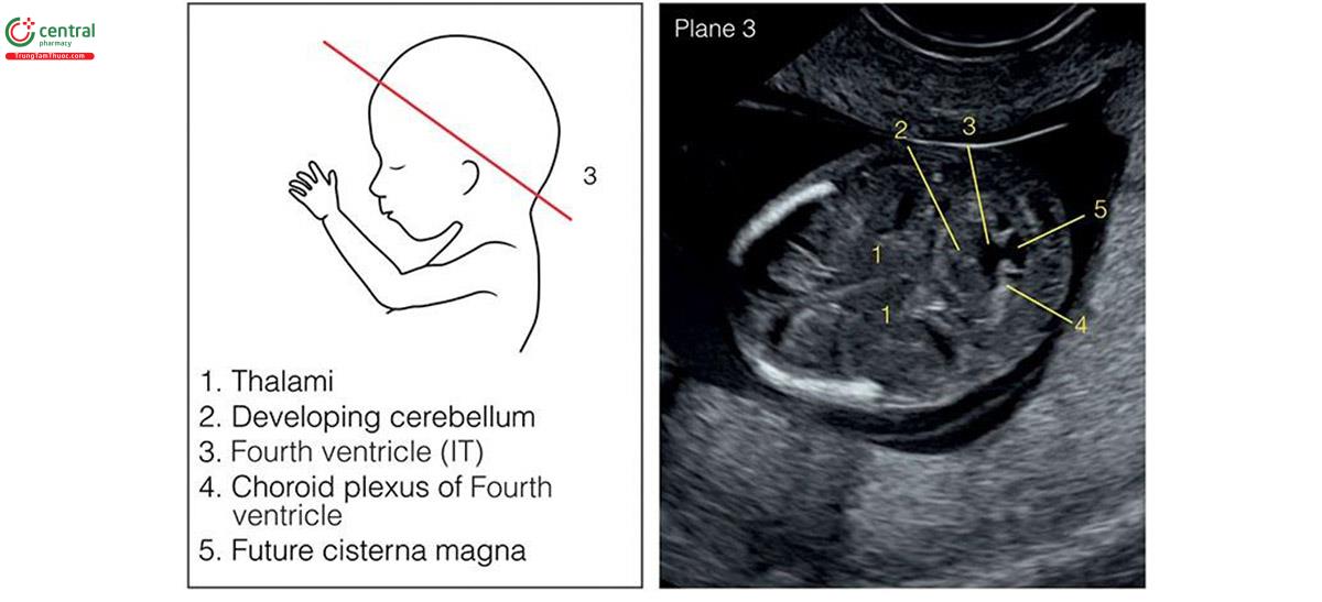 Hình 5.8: Mặt cắt 3 trong số 4 mặt cắt ngang để đánh giá giải phẫu đầu thai nhi: Mặt cắt 3 là mặt cắt ngang hơi chếch ở mức hố sau, cho thấy tiểu não đang phát triển và não thất bốn là khoảng sáng nội sọ (IT). Hố sau có thể được đánh giá dễ dàng hơn ở mặt cắt dọc giữa được thể hiện trong Hình 5.6. Mặt cắt 3 được đánh giá tốt nhất với siêu âm qua ngả âm đạo. Xem Bảng 5.7 và văn bản để biết thêm chi tiết.
