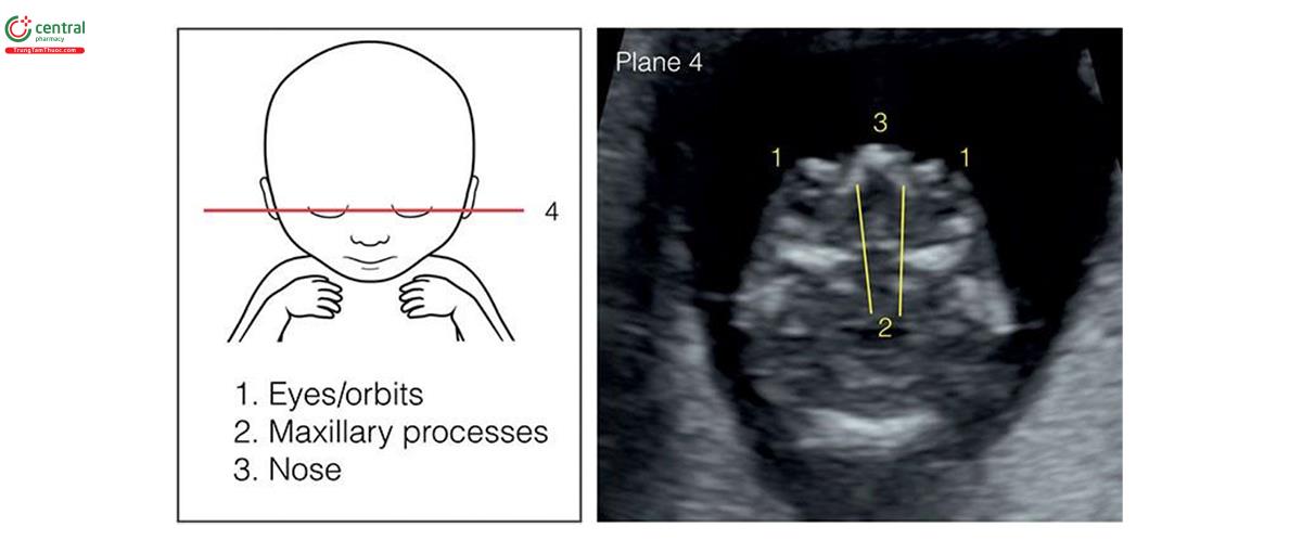 Hình 5.9: Mặt cắt 4 trong số 4 mặt cắt ngang để đánh giá giải phẫu đầu thai nhi: Mặt cắt 4 là mặt cắt ngang hốc mắt cho thấy hai hốc mắt, mắt và mũi ở giữa. Xem văn bản để biết thêm chi tiết. Chú thích, 1 mắt/hốc mắt, 2 mỏm hàm trên, 3 mũi.