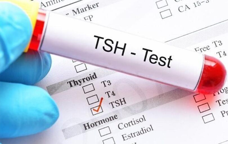 Kiểm tra mức độ hormone kích thích tuyến giáp (TSH).