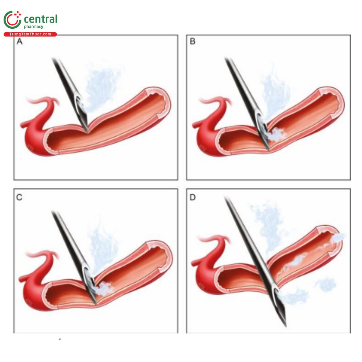 Hình 3. (A) Kim tiếp cận mạch máu. (B) Kim đâm vào mạch máu. (C) Kim đi vào mạch máu. (D) Kim đi qua mạch máu, đưa một lượng rất nhỏ và có thể không đáng kể filler vào mạch máu.