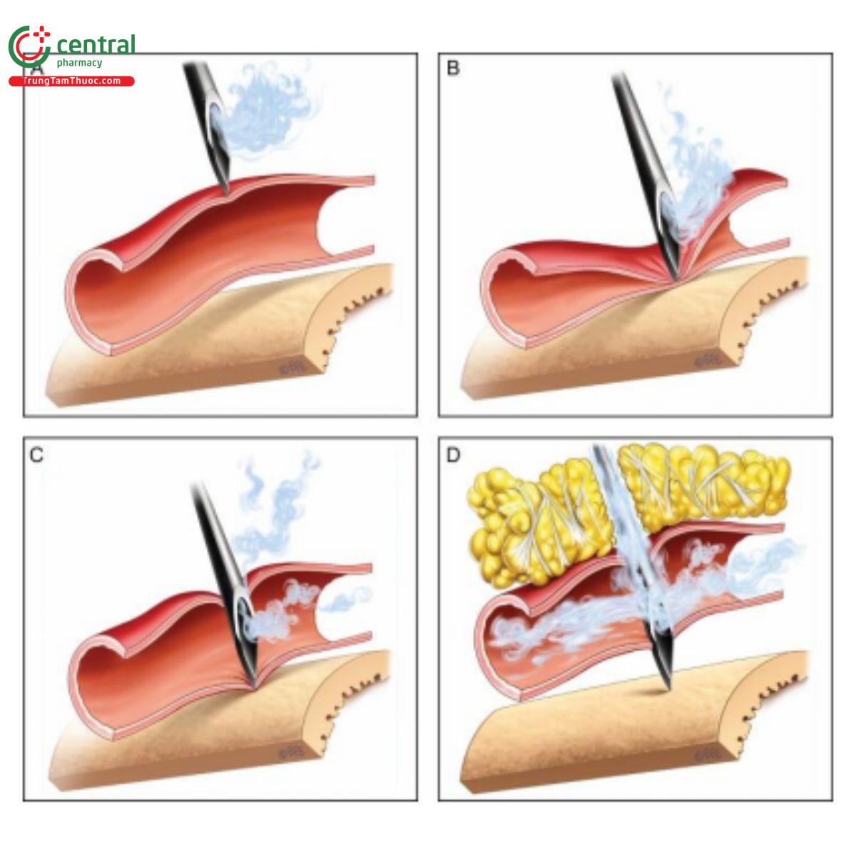 Hình 4. (A) Kim bắt đầu chạm vào nhưng chưa đâm thủng mạch máu. (B) Kim đã xuyên qua mạch máu vào xương nhưng chưa đâm thủng mạch máu. Test máu ở đây sẽ cho kết quả (-). Chuyển động tay trong quá trình test có thể đưa kim vào lại mạch máu hoặc sức cản tăng lên bởi xương với lần tiêm tiếp theo có thể khiến mạch máu bị đâm thủng. (C) Mạch máu bị đâm thủng. Người thực hiện, không biết và yên tâm vì test máu không trúng, có thể tiến hành tiêm bolus. (D) Ngay cả khi mạch máu chỉ xuyên qua một phần vào màng xương, chiều cao thẳng đứng của vát kim và chênh lệch áp suất giữa sức cản của xương đối với áp suất tiêm về phía trước và mạch máu bị đâm thủng làm cho filler chủ yếu đi vào lòng mạch.