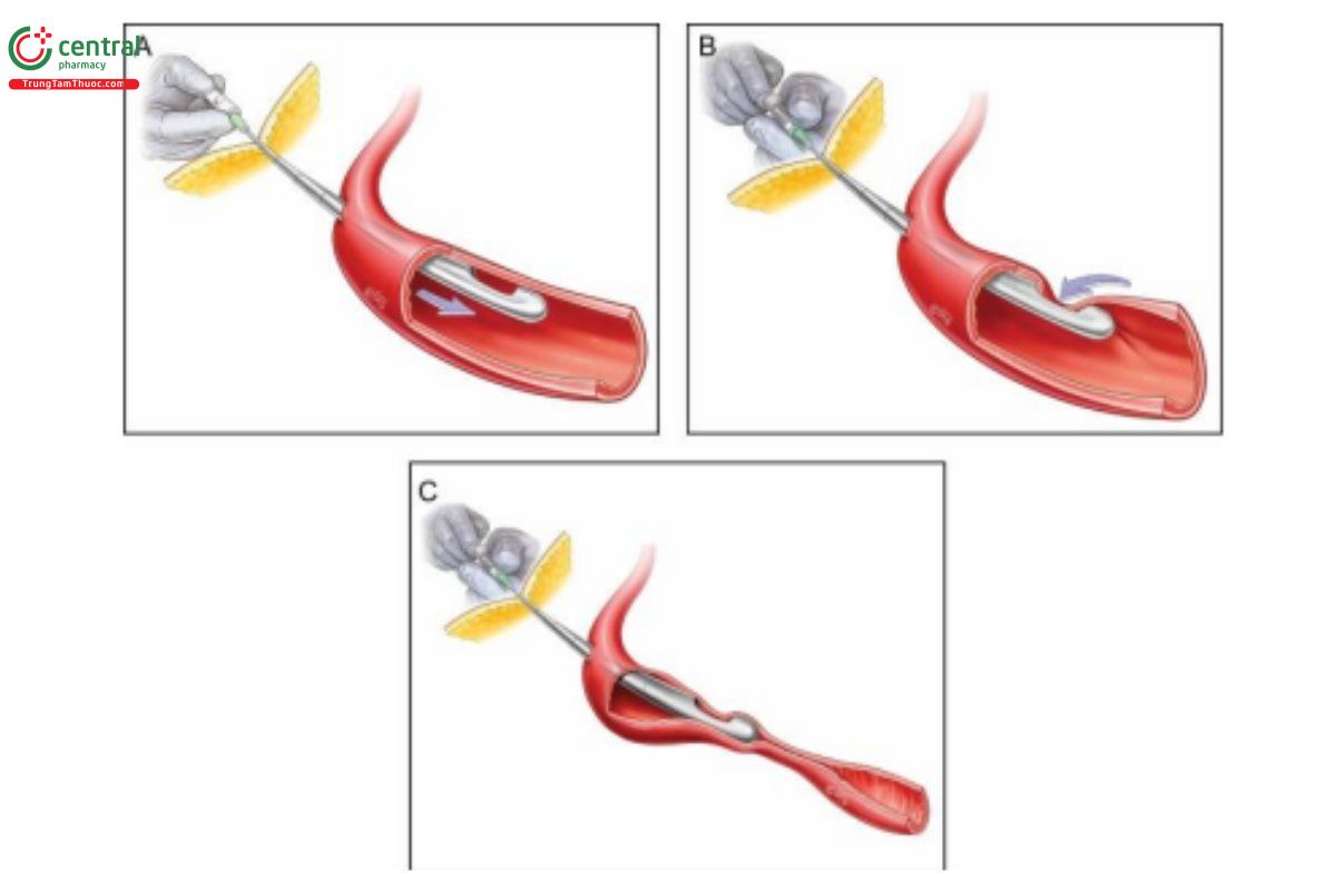 Hình 5. (A) Dụng cụ đã đi vào lòng mạch (ở đây, cannula được sử dụng để minh họa). (B) Dụng cụ đang thực hiện thao tác test máu nhưng đang hút vào thành mạch máu, có khả năng tạo ra kết quả âm tính giả. (C) Dụng cụ đã đi vào mạch máu, nhưng với áp lực hút mạnh, thành mạch có thể bị xẹp, chặn lỗ vát và một lần nữa dẫn đến kết quả âm tính giả.